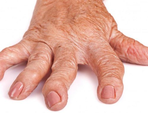 How Strong Is the Association Between the Development of Rheumatoid Arthritis and Inheritance?