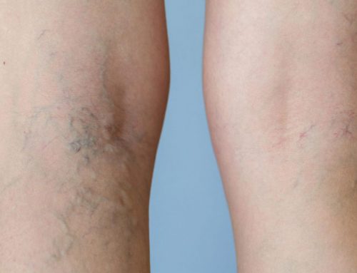 Varicose Veins During Pregnancy