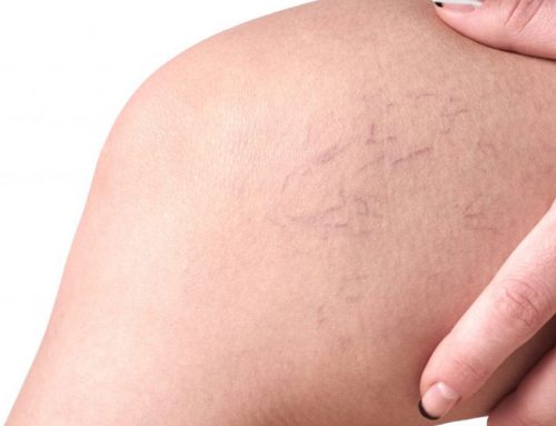 The Significance of Exercise for Varicose Veins
