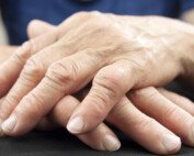 What Is Arthritis Flares?