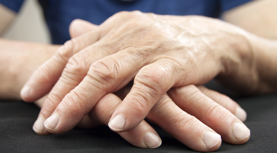 What Is Arthritis Flares?