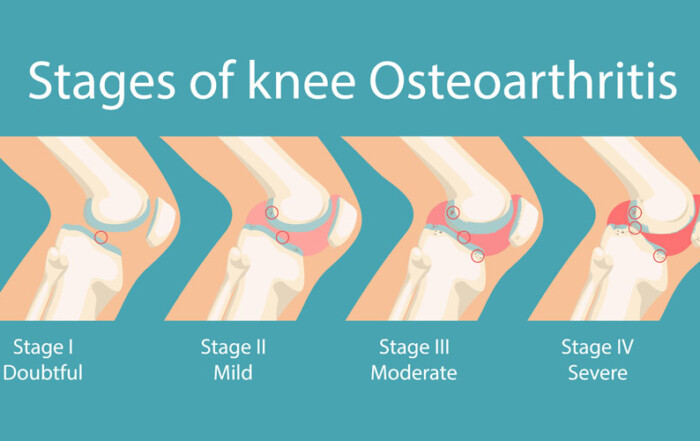 What are the different stages of knee osteoarthritis and possible management?